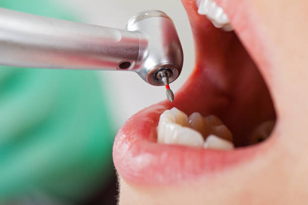 Best Emergency Wisdom Tooth Extraction in Poquoson, VA